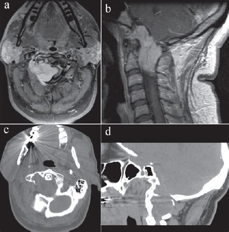 Primary Extramedullary Tumors Of The Craniovertebral Junction Neupsy Key