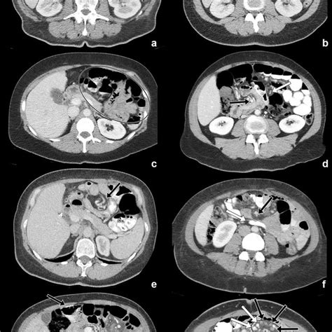 Enhanced Axial Ct Images After Intravenous And Oral Contrast Through