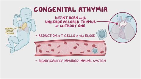 Congenital Athymia Nord Video Anatomy And Definition Osmosis