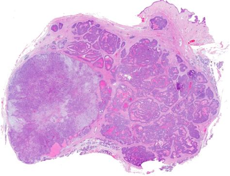 Carcinoma Ex Pleomorphic Adenoma With Particular Emphasis On Early