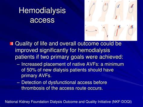 Ppt Hemodialysis Access Powerpoint Presentation Free Download Id