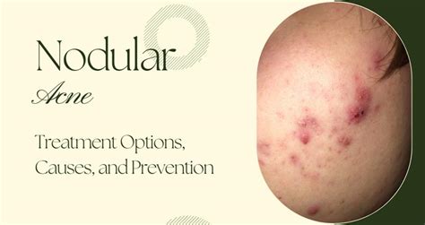 Nodular Acne And Treatment Options Causes Prevention
