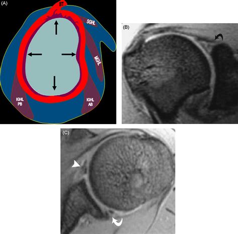 Slap Lesions Anatomy Clinical Presentation Mr Imaging Diagnosis And