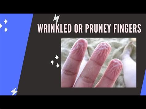 Why Do Fingers Wrinkle In Water Osmosis Youtube