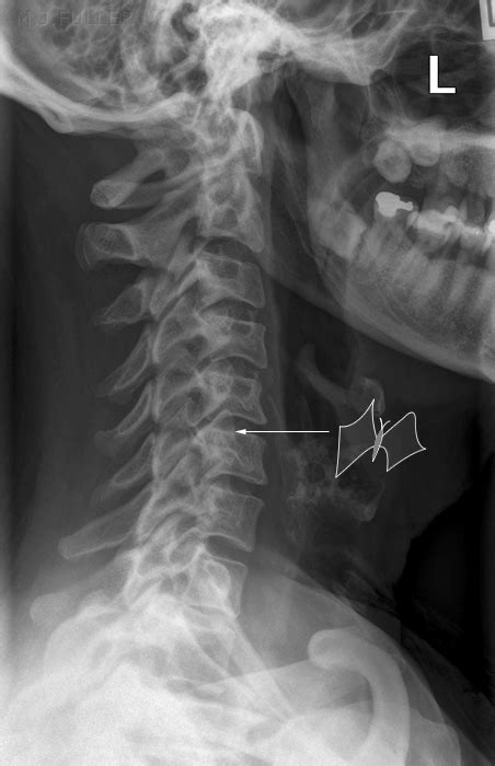 The Trauma Lateral Cervical Spine Wikiradiography