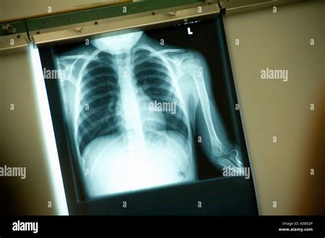 X Ray Of Torso Stock Photo Alamy