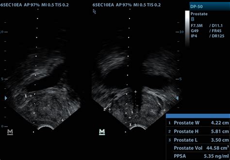 Transrectal Ultrasound And Prostate Biopsy Trus Biopsy — Urology Associates