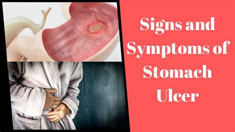 Signs And Symptoms Of Stomach Ulcer Youtube