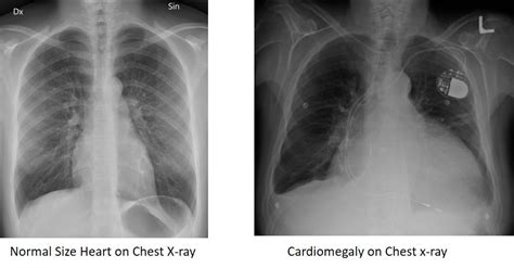 Cardiomegaly Explained By A Cardiologist • Myheart 2023