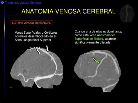 Trombosis Cerebral Venosa Figure From La Trombosis Venosa Cerebral Un