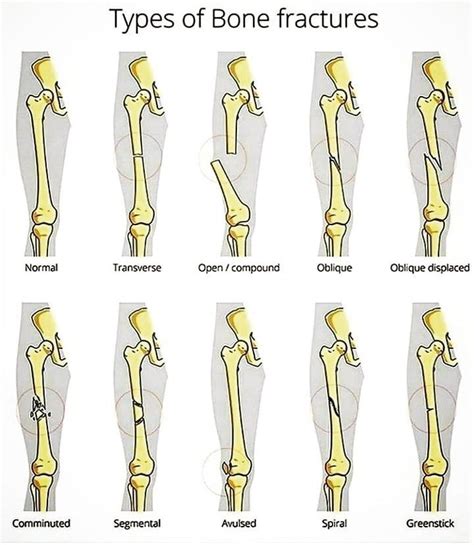 Types Of Bone Fractures Medical Types Of Bones Bone Fracture