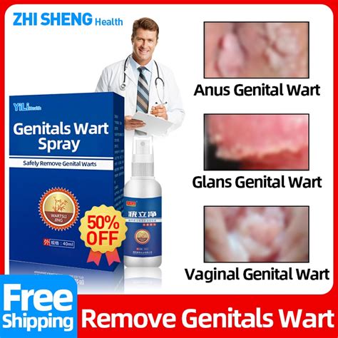 Genital Warts Removal Spray Treatment Condyloma Anus Warts Male Penis