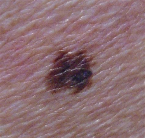 Dermoscopy Melanoma Skin Cancer Can Be Fatal Unless Caught Early But