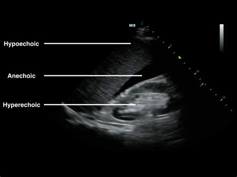 Sonoguide Ultrasound Physics And Technical Facts For The Beginner