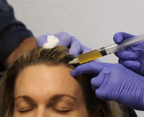 Platelet Rich Plasma For Hair Loss