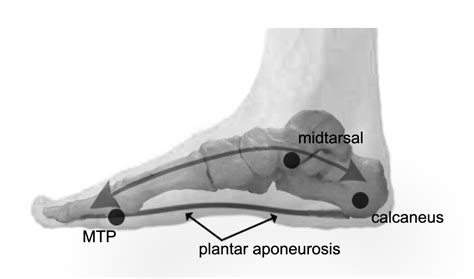 Midtarsal Joint Sprain The Complete Treatment Guide