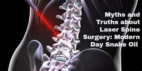 Myths And Truths About Laser Spine Surgery Legacy Spine And Neurological