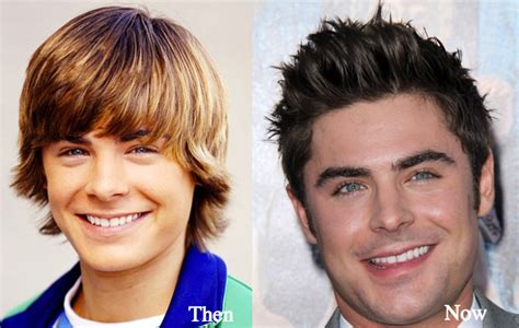 The zac efron plastic surgery really did wonders for this celebrity giving him a more attractive and mature appearance. Zac Efron Plastic Surgery Before and After Photos