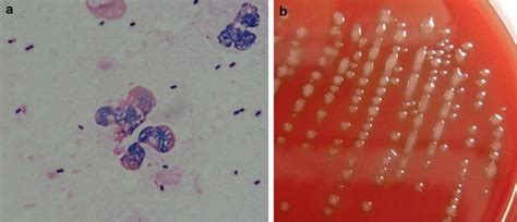 Invasive Pneumococcal Disease Caused By Mucoid Serotype Streptococcus