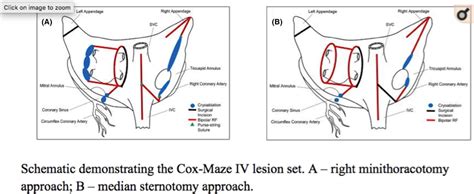 Schematic Demonstrating The Cox‐maze Iv Lesion Set A Right