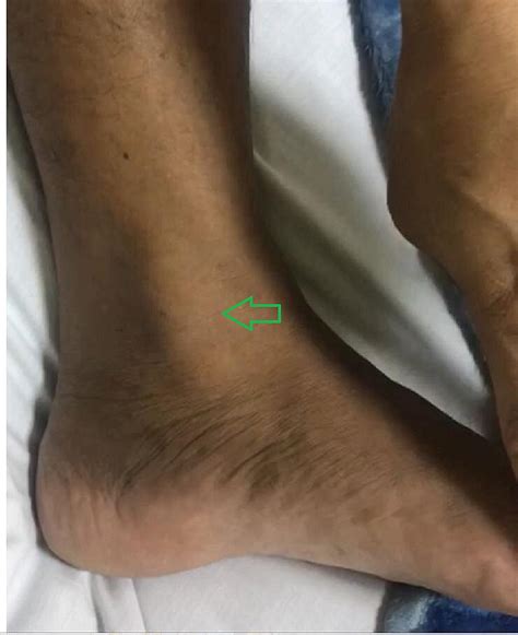 Cureus Traumatic Dislocation Of Tibialis Posterior Tendon A Case The Best Porn Website