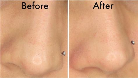 Biore Pore Strips Before And After