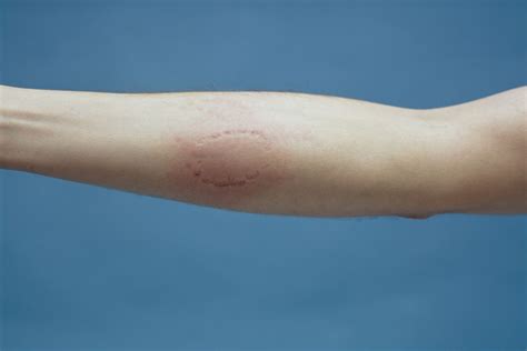 Human Bite Causes Symptoms Risks And Treatment