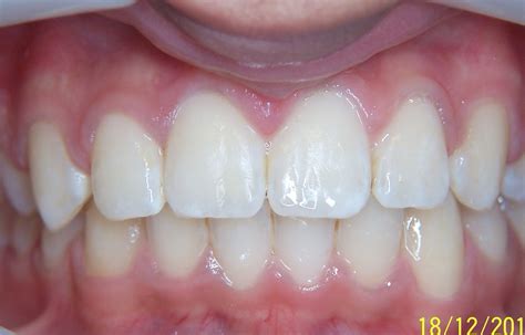 Protruding Front Teeth Ceramic Braces For Children Smile 101