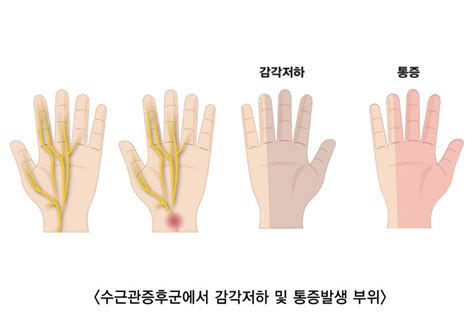 손목터널증후군 손목통증 의심이 된다면 정보력