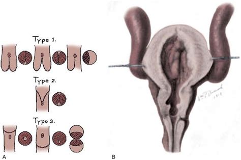 Posterior Urethral Valves Abdominal Key