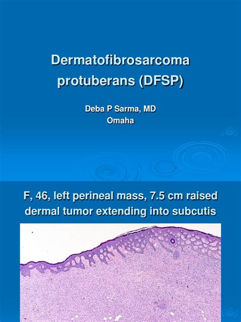 Dermatofibrosarcoma Protuberans Dfsp F 46 Perineal Skin Pdf