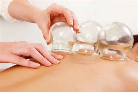 Cupping Therapy Yan Acupuncture And Herbs Authentic Traditional Chinese Medicine