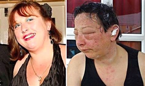 Allergic Reaction To Ppd Can Be Shocking Graphic Image Warning