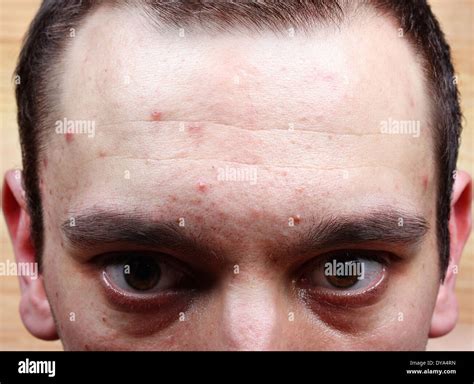 Dermatological Disease Acne Pimples On The Face Of A Man Stock Photo