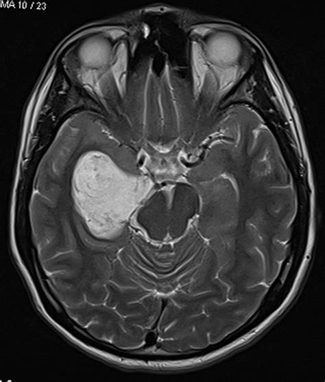 Radiodiagnosis Imaging Is Amazing Interesting Cases Epidermoid