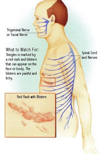 The best prevention of phn is the prevention of herpes zoster. Pin on Allergies, Food Sensitivity and Environmental