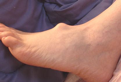 Ganglion cysts are noncancerous lumps that most commonly develop along the tendons or joints of your wrists or hands. Ganglion Cyst Foot - Columbus Podiatry & Surgery