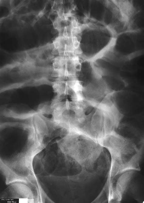 A Case Of Clozapine Induced Paralytic Ileus Emergency Medicine Journal