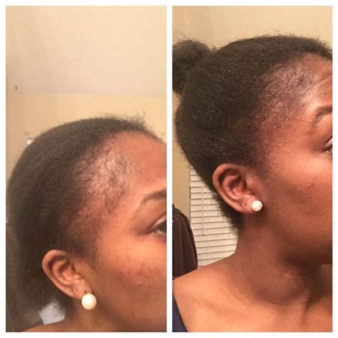 7days hair regrowth serum helps reactivate dormant hair follicles that have slowed down over the years and ultimately caused thinning strands and hair loss. Hair Oil Formula D Hair ReGrowth Serum For Fast Hair ...