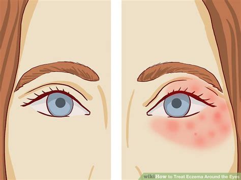 How To Treat Eczema Around The Eyes How To Treat Eczema Eczema
