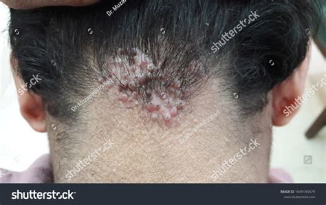 1 Acne Keloidalis Nuchae Images Stock Photos And Vectors Shutterstock