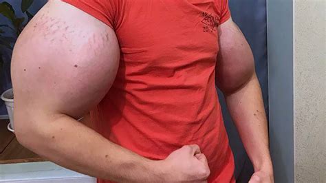Man With Huge Popeye Arms Could Lose Them According To Doctors