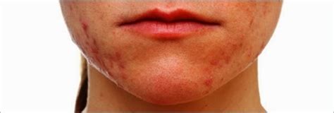 How To Fix Acne Scars By John How To Get Rid Of Chin Acne Tips