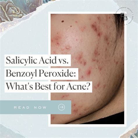 Salicylic Acid Vs Benzoyl Peroxide What S Best For Acne Enlightened Beauty By Morgan Elizabeth