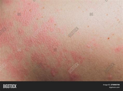 Close Up Allergy Rash Around Back View Of Human With Dermatitis