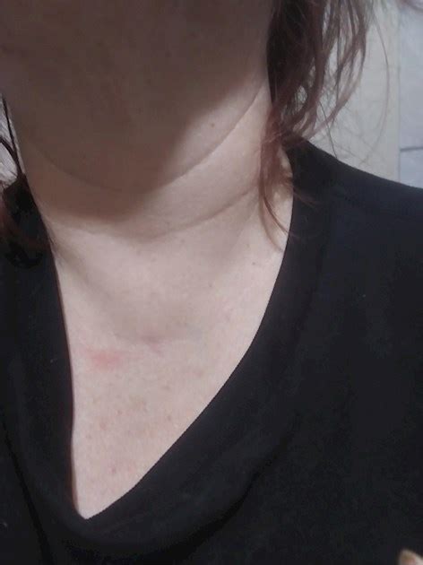 Lump Between My Collarbone Hello My Name Is Thyroid Uk