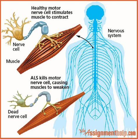 Things You Should Know About Amyotrophic Lateral Sclerosis Als