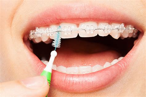 Clear Braces What Foods Should You Avoid Burbank Valley Dental
