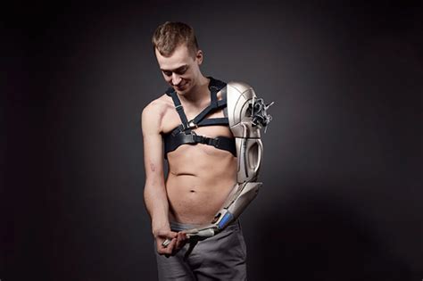 London Man Receives Bionic Arm With A Usb Port And Built