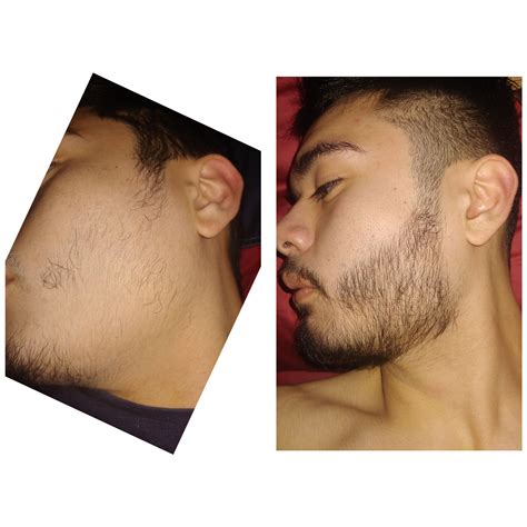 Minoxidil has been shown to help men grow hair on their head but many men wonder, is some men see results in as soon as three months, but most take several months to a year to see any many men do report that after using minoxidil for beards, it helped them to grow a thicker and fuller beard. Minoxidil Beard Reddit Before And After Pictures | Beard ...